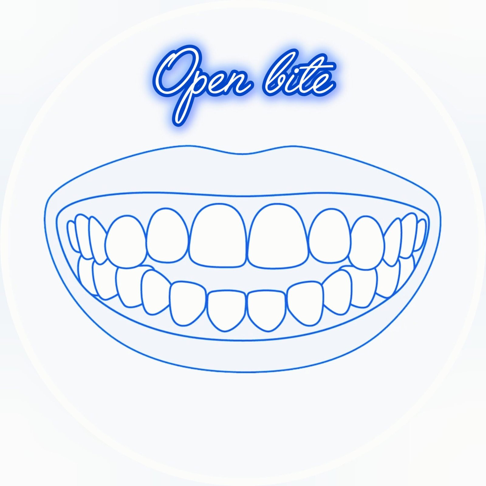 Open Bite